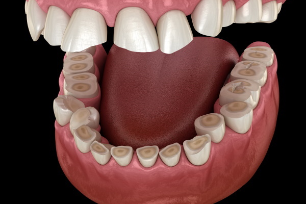 東京駅（京橋駅）徒歩2分の歯医者、精密根管治療、村岡歯科医院の顎関節症