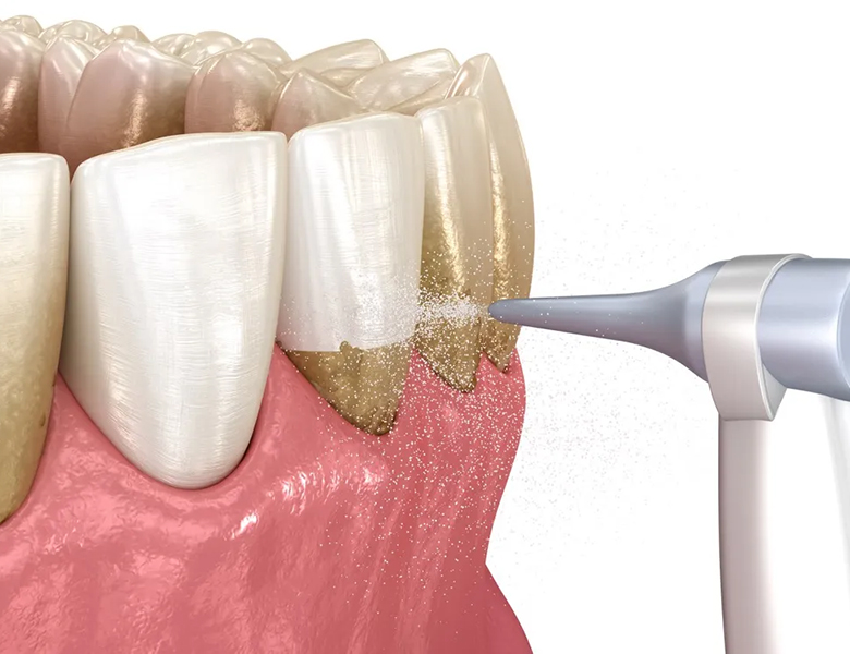 東京駅（京橋駅）徒歩2分の歯医者、精密根管治療、村岡歯科医院の歯周病治療