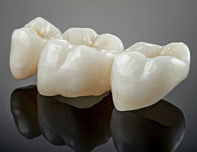 東京駅（京橋駅）徒歩2分の歯医者、精密根管治療、村岡歯科医院のブリッジ