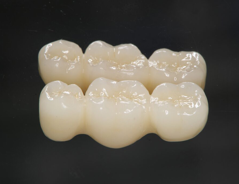 東京駅（京橋駅）徒歩2分の歯医者、精密根管治療、村岡歯科医院でブリッジ