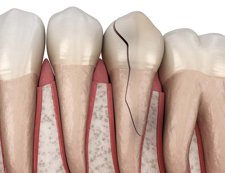 東京駅（京橋駅）徒歩2分の歯医者、精密根管治療、村岡歯科医院の歯ぎしり、食いしばり
