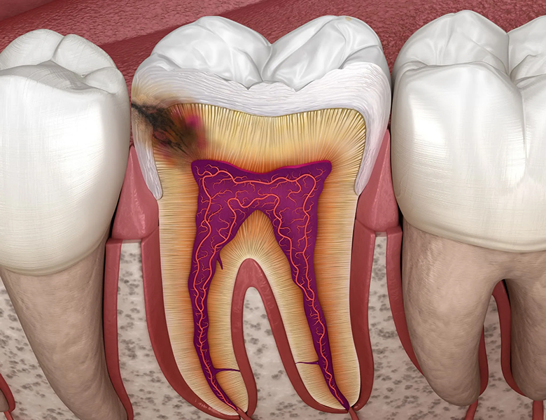 東京駅（京橋駅）徒歩2分の歯医者、精密根管治療、村岡歯科医院でむし歯治療