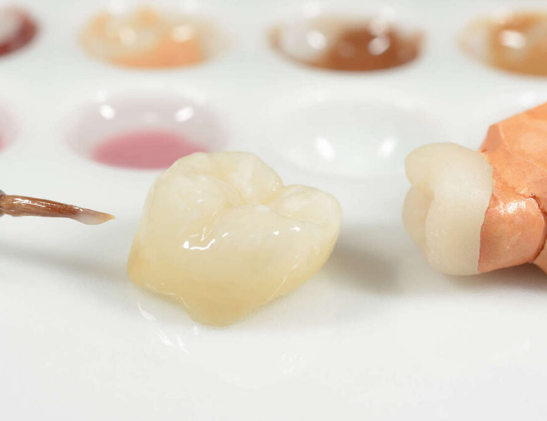 東京駅（京橋駅）徒歩2分の歯医者、精密根管治療、村岡歯科医院で補綴治療（詰め物・被せ物）