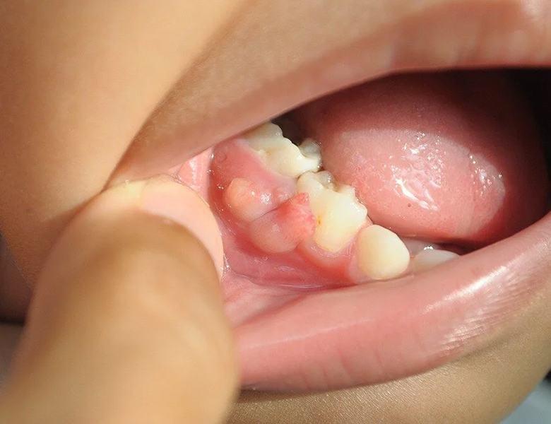 東京駅（京橋駅）徒歩2分の歯医者、精密根管治療、村岡歯科医院のお口の中のデキモノ