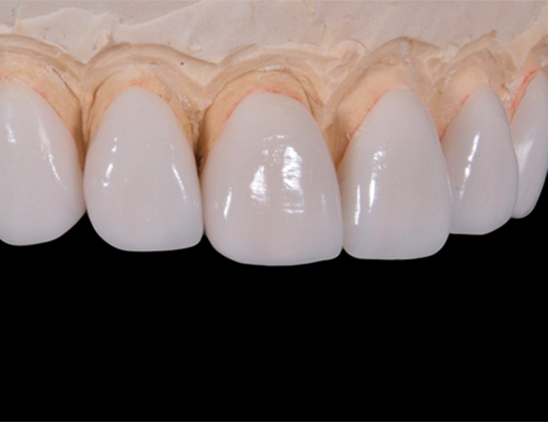 東京駅（京橋駅）徒歩2分の歯医者、精密根管治療、村岡歯科医院の補綴治療（詰め物・被せ物）