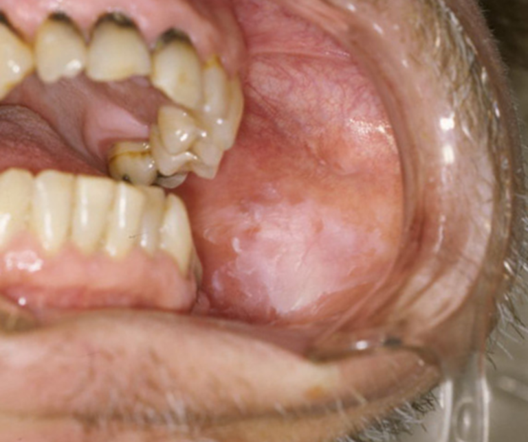 東京駅（京橋駅）徒歩2分の歯医者、精密根管治療、村岡歯科医院のお口の中のデキモノ