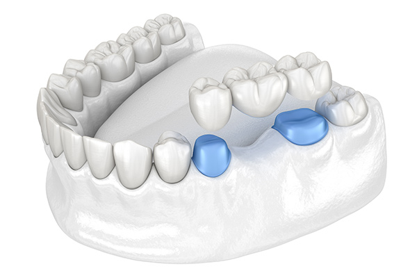 東京駅（京橋駅）徒歩2分の歯医者、精密根管治療、村岡歯科医院のブリッジ
