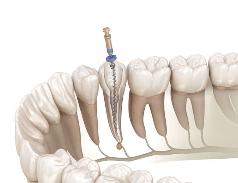東京駅（京橋駅）徒歩2分の歯医者、精密根管治療、村岡歯科医院で根管治療