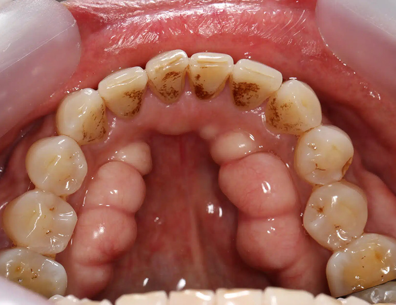 東京駅（京橋駅）徒歩2分の歯医者、精密根管治療、村岡歯科医院の歯ぎしり、食いしばり