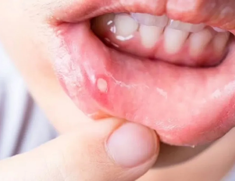 東京駅（京橋駅）徒歩2分の歯医者、精密根管治療、村岡歯科医院のお口の中のデキモノ