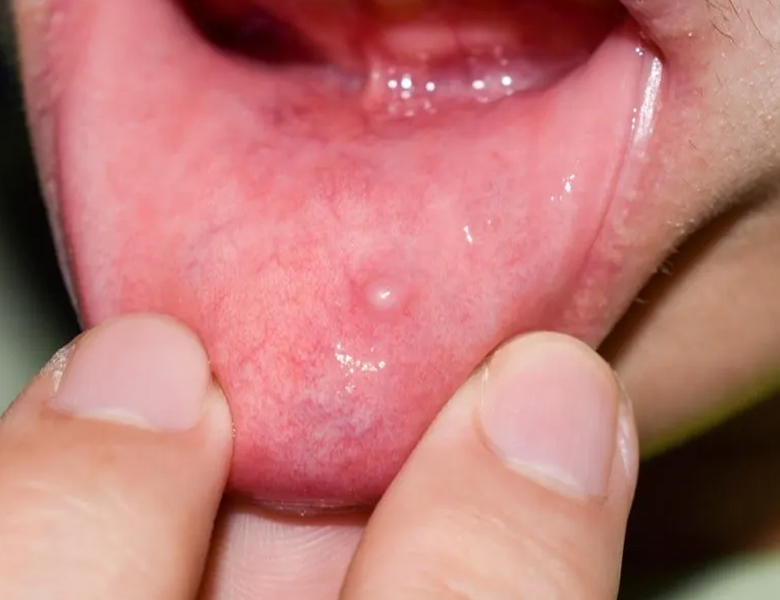 東京駅（京橋駅）徒歩2分の歯医者、精密根管治療、村岡歯科医院のお口の中のデキモノ