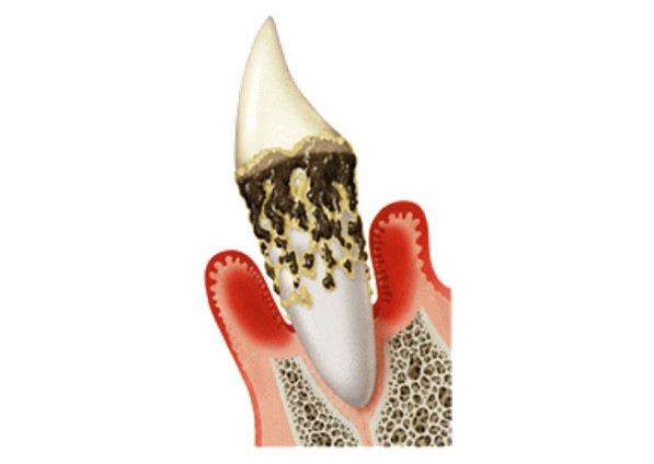 東京駅（京橋駅）徒歩2分の歯医者、精密根管治療、村岡歯科医院の歯周病治療