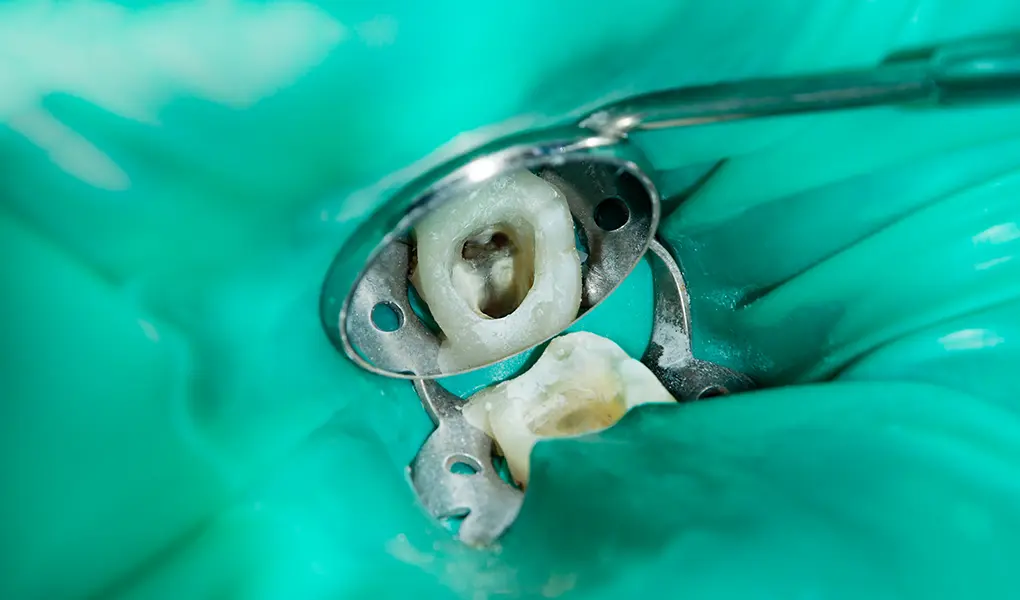 東京駅（京橋駅）徒歩2分の歯医者、精密根管治療、村岡歯科医院の精密根管治療