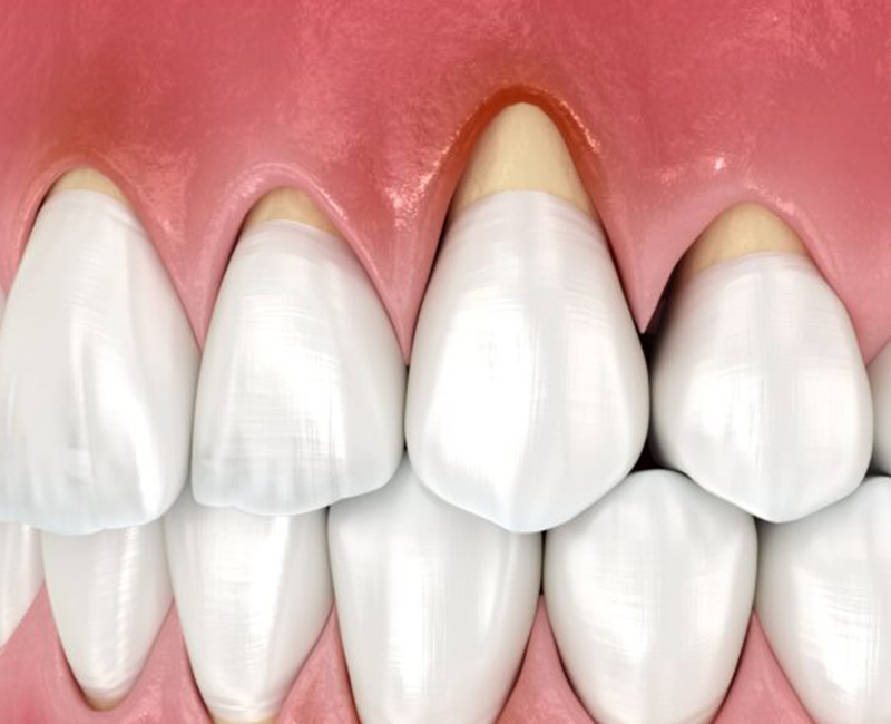 東京駅（京橋駅）徒歩2分の歯医者、精密根管治療、村岡歯科医院の歯ぎしり、食いしばり